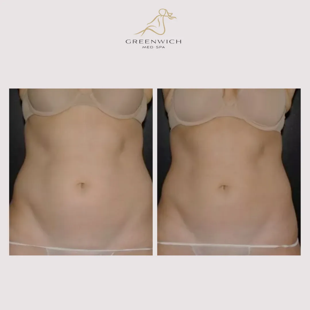 SheerSculpt - The Top CoolSculpting Clinic Serving the Tri State Area